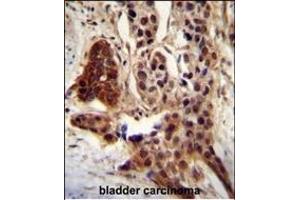 CCD antibody (C-term) (ABIN654810 and ABIN2844484) immunohistochemistry analysis in formalin fixed and paraffin embedded human bladder carcinoma followed by peroxidase conjugation of the secondary antibody and DAB staining. (CCDC122 antibody  (C-Term))