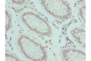Immunohistochemistry of paraffin-embedded human colon cancer using ABIN7152238 at dilution of 1:100 (SLC1A6 antibody  (AA 149-271))