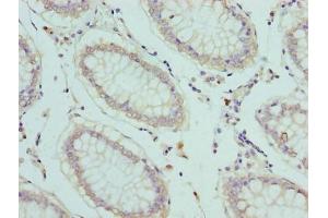 Immunohistochemistry of paraffin-embedded human colon cancer using ABIN7152238 at dilution of 1:100