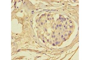 Immunohistochemistry of paraffin-embedded human breast cancer using ABIN7153665 at dilution of 1:100 (Non-Syndromic Hearing Impairment Protein 5 (GSDME) (AA 1-496) antibody)