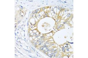 Immunohistochemistry of paraffin-embedded human colon carcinoma using GNAI3 antibody.