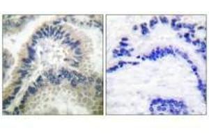 Immunohistochemical analysis of paraffin-embedded human lung carcinoma tissue using Guanylate Cyclase β antibody. (GUCY1B3 antibody)