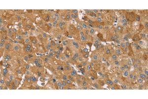 Immunohistochemistry of paraffin-embedded Human liver cancer using TRIM34 Polyclonal Antibody at dilution of 1:30 (TRIM34 antibody)