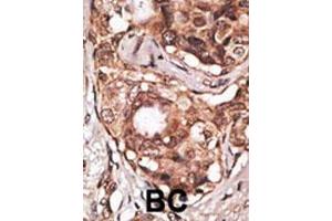 Formalin-fixed and paraffin-embedded human cancer tissue reacted with the primary antibody, which was peroxidase-conjugated to the secondary antibody, followed by DAB staining. (MAGEB2 antibody  (N-Term))