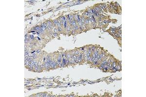 Immunohistochemistry of paraffin-embedded human colon carcinoma using UBE2S antibody. (UBE2S antibody  (AA 122-221))
