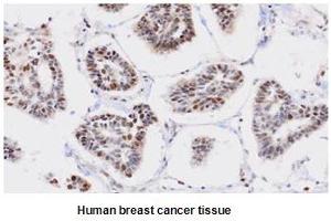 Paraffin embedded sections of human breast cancer tissue were incubated with anti-human PPM1G (1:50) for 2 hours at room temperature. (PPM1G antibody)