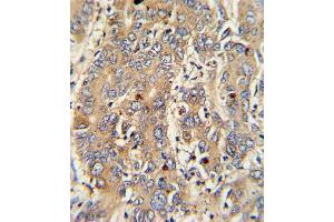 Formalin-fixed and paraffin-embedded human hepatocarcinoma with PIGR Antibody , which was peroxidase-conjugated to the secondary antibody, followed by DAB staining. (Stathmin 1 antibody  (C-Term))