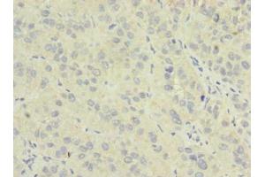Immunohistochemistry of paraffin-embedded human liver cancer using ABIN7162044 at dilution of 1:100 (NME7 antibody  (AA 1-150))