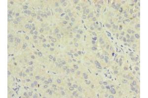 Immunohistochemistry of paraffin-embedded human liver cancer using ABIN7162044 at dilution of 1:100