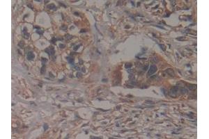 Detection of GCLM in Human Pancreatic cancer Tissue using Polyclonal Antibody to Glutamate Cysteine Ligase, Modifier Subunit (GCLM)