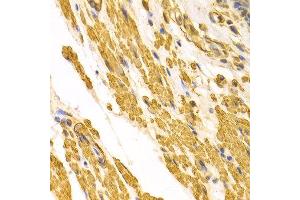Immunohistochemistry of paraffin-embedded human gastric cancer using CYP2E1 antibody at dilution of 1:100 (x400 lens).