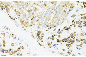 Immunohistochemistry of paraffin-embedded Human lung cancer using IRF1 Polyclonal Antibody (IRF1 antibody)