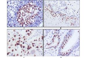 Immunohistochemical analysis of paraffin-embedded human lymph node (A), esophagus (B), lung cancer (C), rectum cancer (D), showing nuclear localization using KI67 antibody with DAB staining.