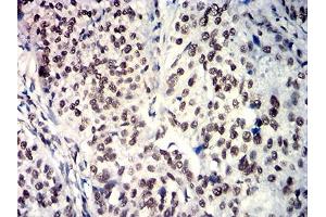 Immunohistochemical analysis of paraffin-embedded bladder cancer tissues using SOX11 mouse mAb with DAB staining. (SOX11 antibody  (AA 1-250))