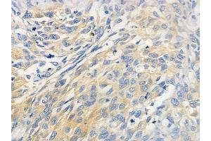 ABIN6259053 and ABIN6274399 at 1/100 staining human lung squamous cell carcinoma by IHC-P. (LDOC1L antibody  (Internal Region))