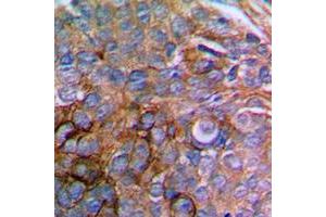 Immunohistochemical analysis of Paxillin staining in human prostate cancer formalin fixed paraffin embedded tissue section. (Paxillin antibody  (N-Term))