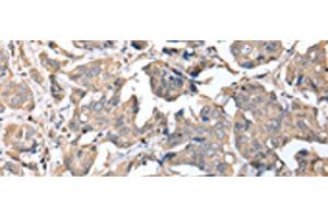Immunohistochemistry of paraffin-embedded Human breast cancer tissue using KCTD16 Polyclonal Antibody at dilution of 1:25(x200) (KCTD16 antibody)