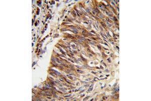 Formalin-fixed and paraffin-embedded human lung carcinoma reacted with ALDH3B1 Antibody (Center), which was peroxidase-conjugated to the secondary antibody, followed by DAB staining. (ALDH3B1 antibody  (AA 334-360))