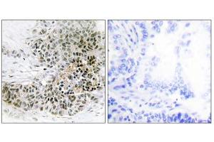 Immunohistochemistry analysis of paraffin-embedded human lung carcinoma tissue, using TRPS1 antibody. (TRPS1 antibody  (N-Term))