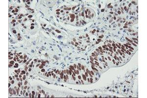 Immunohistochemical staining of paraffin-embedded Carcinoma of Human pancreas tissue using anti-TP53 mouse monoclonal antibody.