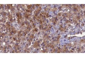 ABIN6276934 at 1/100 staining Human liver cancer tissue by IHC-P. (GABRB2 antibody  (N-Term))