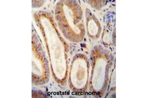 WFDC12 antibody (C-term) immunohistochemistry analysis in formalin fixed and paraffin embedded human prostate carcinoma followed by peroxidase conjugation of the secondary antibody and DAB staining. (WFDC12 antibody  (C-Term))