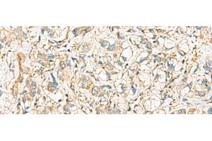 Immunohistochemistry of paraffin-embedded Human liver cancer tissue using IDS Polyclonal Antibody at dilution of 1:60(x200) (IDS antibody)
