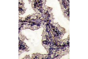 Formalin-fixed and paraffin-embedded prostata carcinoma tissue reacted with LTF Antibody (Center) (ABIN1882099 and ABIN2841775) , which was peroxidase-conjugated to the secondary antibody, followed by DAB staining. (Lactoferrin antibody  (AA 219-248))