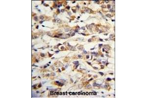 Formalin-fixed and paraffin-embedded human breast carcinoma with KRT14 Antibody (Center), which was peroxidase-conjugated to the secondary antibody, followed by DAB staining. (KRT14 antibody  (AA 276-303))