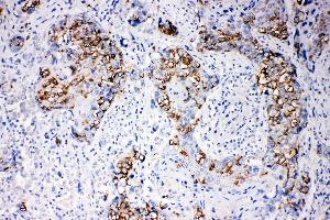 Anti-beta Arrestin 1 antibody, IHC(P) IHC(P): Human Mammary Cancer Tissue (beta Arrestin 1 antibody  (N-Term))