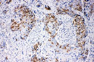 Anti-beta Arrestin 1 antibody, IHC(P) IHC(P): Human Mammary Cancer Tissue