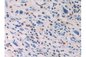 DAB staining on IHC-P;;Samples: Human Stomach cancer Tissue (PTGDS antibody  (AA 1-199))