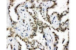 Anti-HDAC3 antibody,  IHC(P) IHC(P): Human Lung Cancer Tissue (HDAC3 antibody  (C-Term))