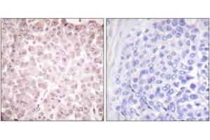 Immunohistochemistry analysis of paraffin-embedded human breast carcinoma tissue, using RCBTB1 Antibody.