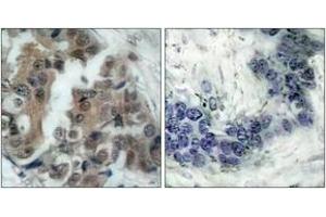 Immunohistochemistry analysis of paraffin-embedded human breast carcinoma, using BAD (Phospho-Ser136) Antibody. (BAD antibody  (pSer99))