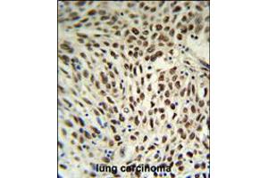 SNRPD3 Antibody IHC analysis in formalin fixed and paraffin embedded human lung carcinoma followed by peroxidase conjugation of the secondary antibody and DAB staining. (SNRPD3 antibody  (C-Term))