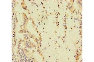 Immunohistochemistry of paraffin-embedded human lung cancer using ABIN7170492 at dilution of 1:100 (SPEM1 antibody  (AA 50-309))