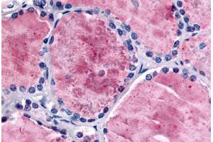 Human Thyroid (formalin-fixed, paraffin-embedded) stained with PDE8B antibody ABIN213536 at 5 ug/ml followed by biotinylated goat anti-rabbit IgG secondary antibody ABIN481713, alkaline phosphatase-streptavidin and chromogen. (PDE8B antibody  (Internal Region))