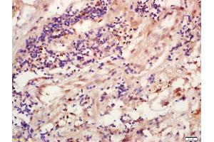 Formalin-fixed and paraffin embedded human lung carcinoma labeled with Anti-TRIB3 Polyclonal Antibody, Unconjugated (ABIN872793) at 1:200 followed by conjugation to the secondary antibody and DAB staining (TRIB3 antibody  (AA 201-300))