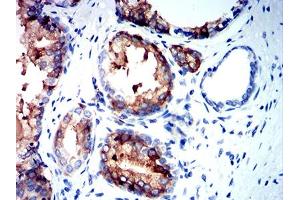 Immunohistochemical analysis of paraffin-embedded prostate cancer tissues using NEFH mouse mAb with DAB staining. (NEFH antibody  (AA 2-251))