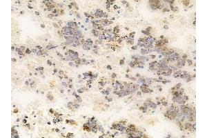 ABIN6265864 and ABIN6266898 at 1/100 staining human melanoma by IHC-P.