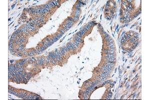 Immunohistochemical staining of paraffin-embedded Adenocarcinoma of Human colon tissue using anti-KHK mouse monoclonal antibody.