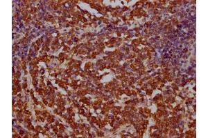 IHC image of ABIN7145214 diluted at 1:100 and staining in paraffin-embedded human lung cancer performed on a Leica BondTM system.