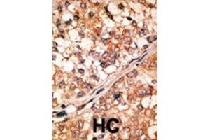 Formalin-fixed and paraffin-embedded human cancer tissue reacted with the primary antibody, which was peroxidase-conjugated to the secondary antibody, followed by DAB staining. (BIM antibody  (AA 130-165))