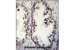 DDX27 Antibody immunohistochemistry analysis in formalin fixed and paraffin embedded human prsotate carcinoma followed by peroxidase conjugation of the secondary antibody and DAB staining. (DDX27 antibody  (C-Term))