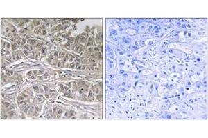 Immunohistochemistry analysis of paraffin-embedded human liver carcinoma tissue, using SLC25A21 Antibody. (SLC25A21 antibody  (AA 134-183))