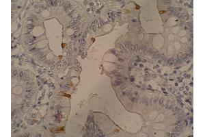 Immunohistochemistry staining of sialyl-Lewis a in colorectal adenocarcinoma (paraffin-embedded sections) with 121SLE antibody. (CA 19-9 antibody)