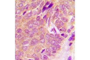 Immunohistochemical analysis of SYK staining in human breast cancer formalin fixed paraffin embedded tissue section.