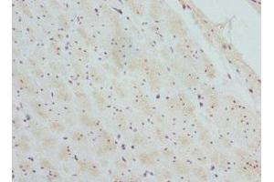 Immunohistochemistry of paraffin-embedded human colon cancer using ABIN7145457 at dilution of 1:100 (CTNNBL1 antibody  (AA 264-563))