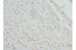 Immunohistochemistry of paraffin-embedded human colon cancer using ABIN7145457 at dilution of 1:100 (CTNNBL1 antibody  (AA 264-563))